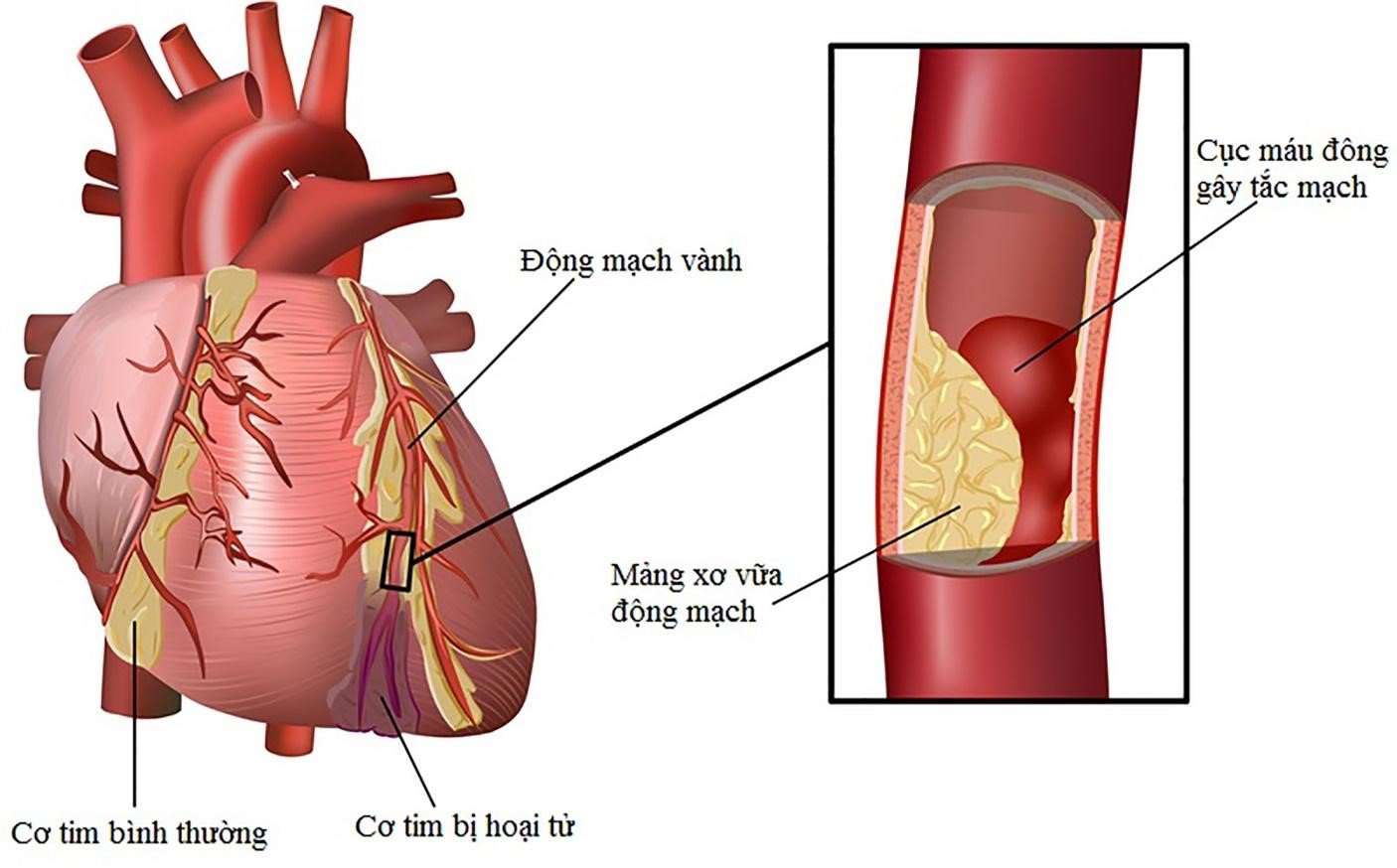 Rối loạn mỡ máu gây xơ vữa động mạch